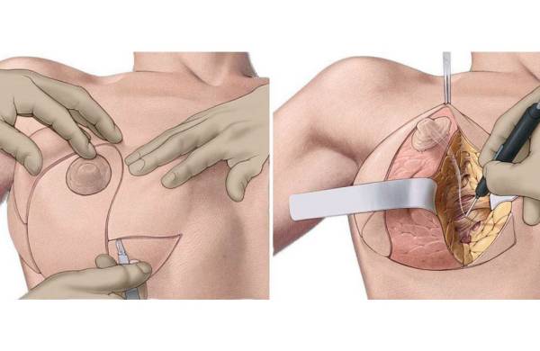 Методы хирургической подтяжки груди и показания для операции