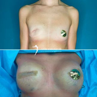 41 год, реконструкция груди после удаления + увеличение груди круглыми имплантатами 250 мл