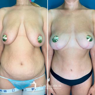 сочетательная пластическая операция: липосакция + абдоминопластика + подтяжка груди без имплантатов