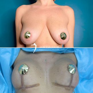 Уменьшение груди без имплантатов