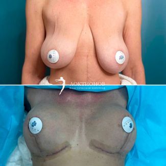 подтяжка груди без имплантатов за счет собственных тканей пациентки