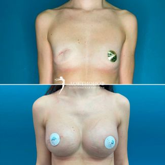 Увеличение груди с имплантатами и реконструкция груди