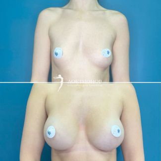 Увеличение груди с имплантатами 320 мл