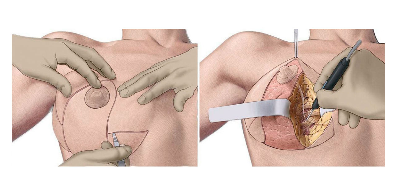 Операция по подтяжке груди: методы хирургической подтяжки груди и показания для операции