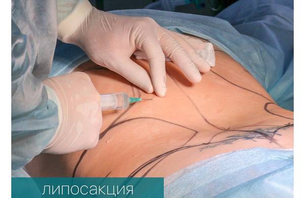 Липосакция спины в Москве, цены на пластическую хирургию