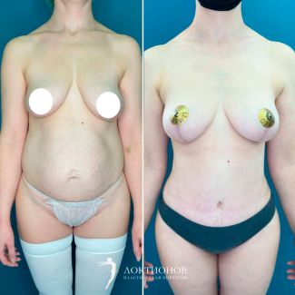 липосакция + абдоминопластика + подтяжка груди без имплантатов - 3 месяца после операции