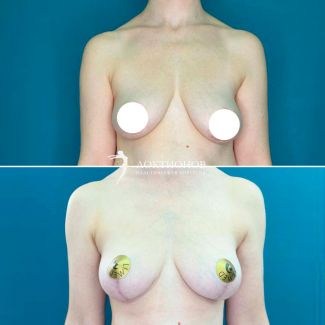 подтяжка груди без имплантатов - 3 месяца после операции
