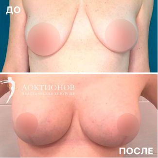 увеличение груди с имплантатами круглой формы + устранение асимметрии