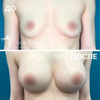 увеличение груди с имплантатами