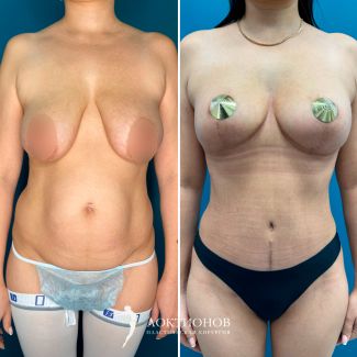 мастопексия груди без имплантатов