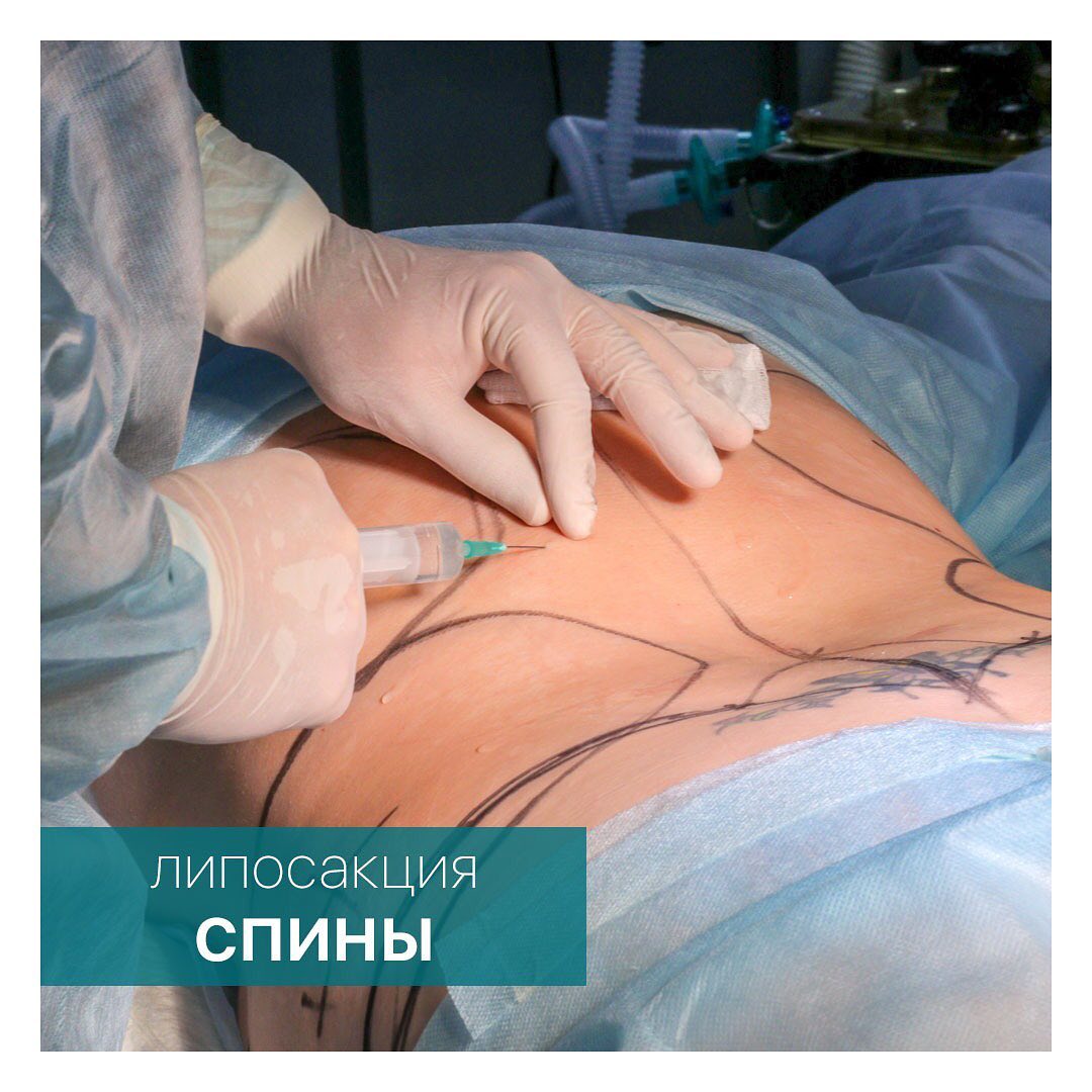 Липосакция спины в Москве, цены на пластическую хирургию