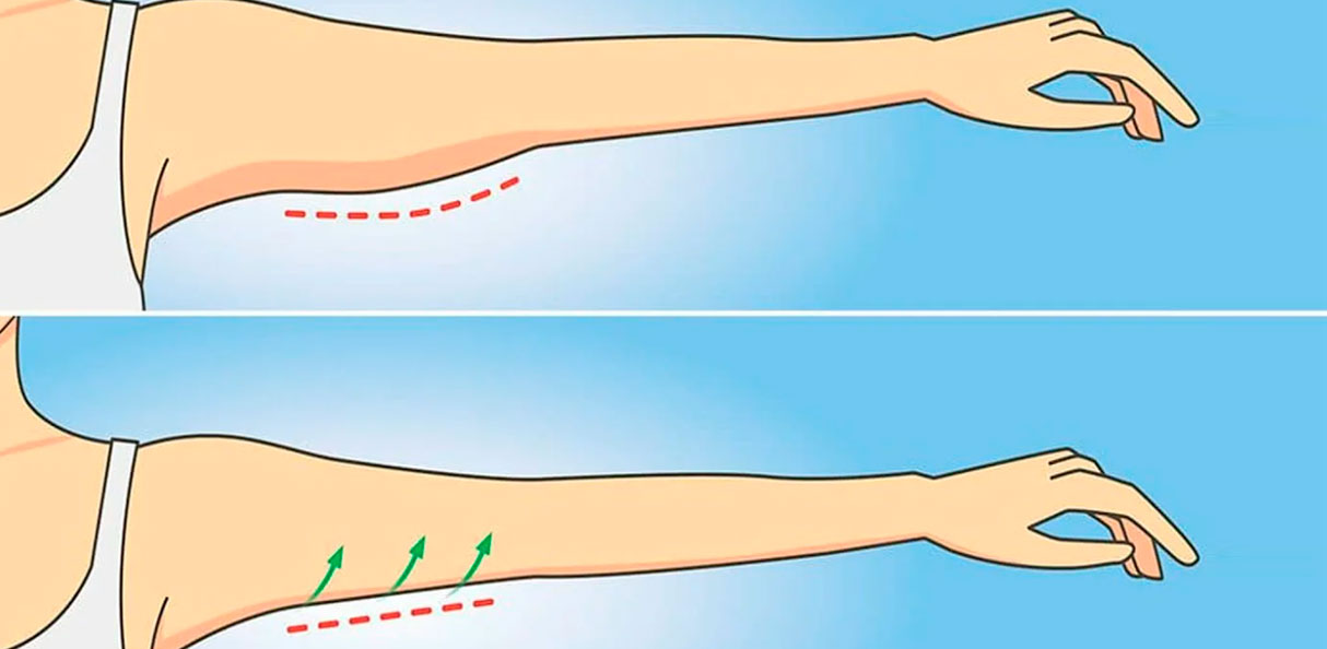 Хирургическая подтяжка рук: как избавиться от излишков кожи на руках