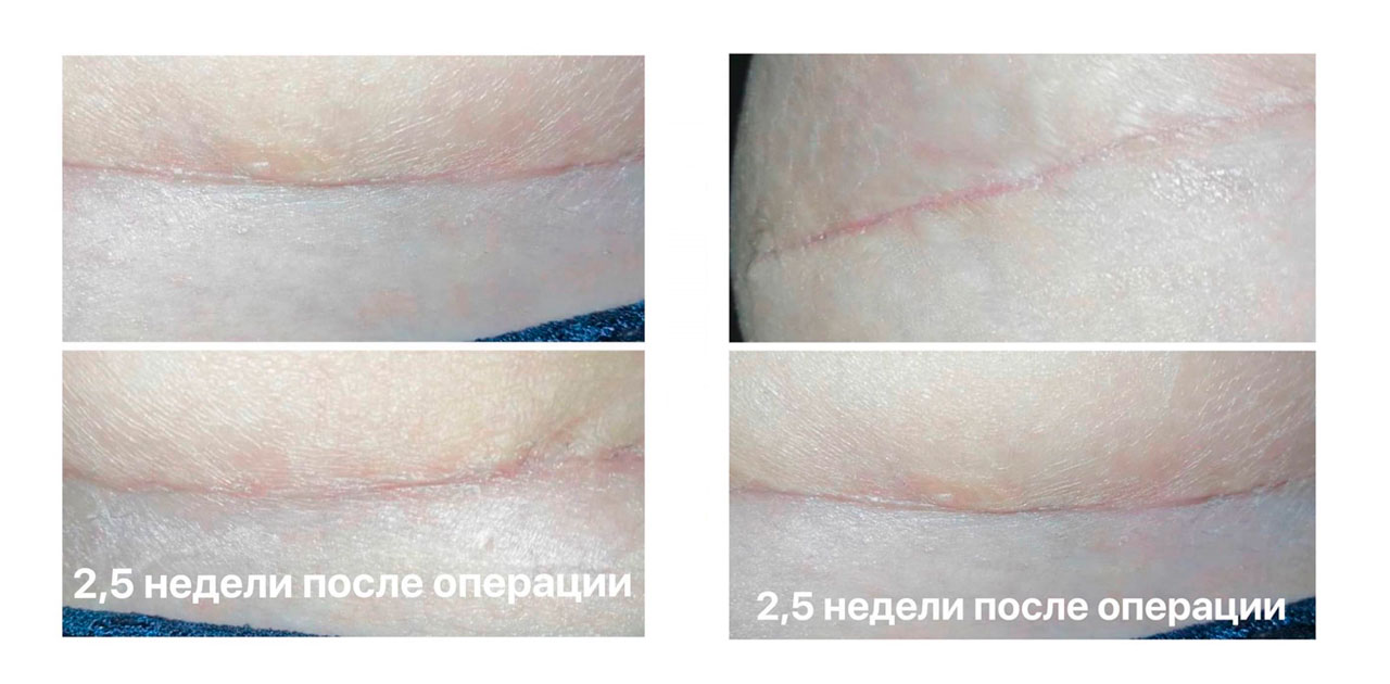 Швы после подтяжки груди: фото до и после, реабилитация | Институт красоты ГАЛАКТИКА