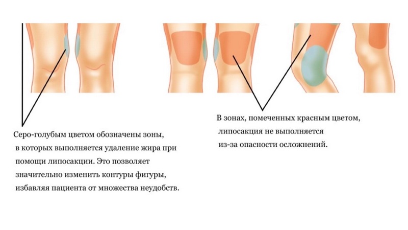 Липосакция коленей в Москве для женщин и мужчин, фото до и после, цены на операцию