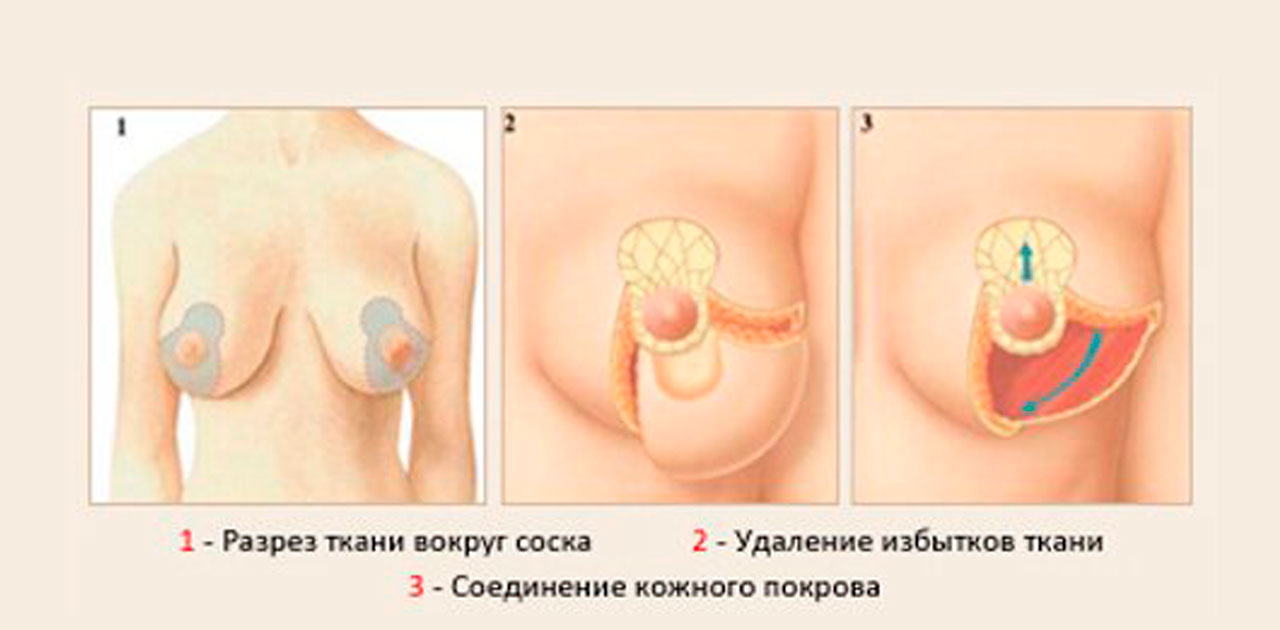 Как вы будете чувствовать себя после уменьшения груди (редукционной  мастопексии)