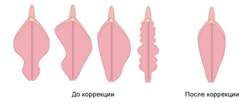 лабиопластика или интимная пластика малых и больших половых губ